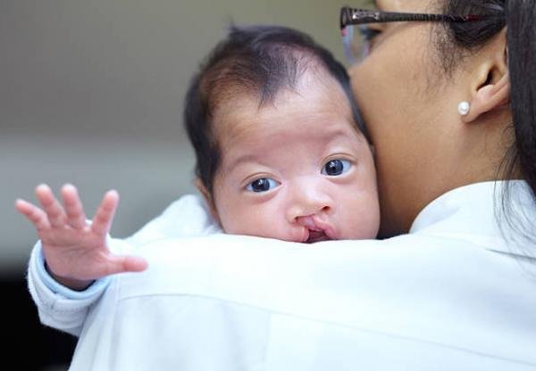 Hospital Infantil oferta cirurgia gratuita para fissura labial em crianças